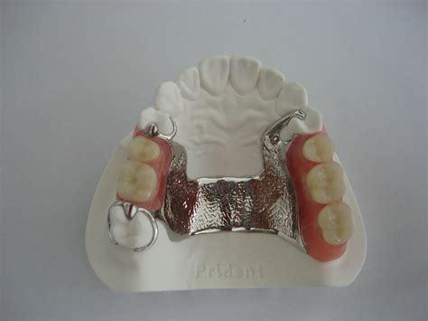 removable partial denture cast metal